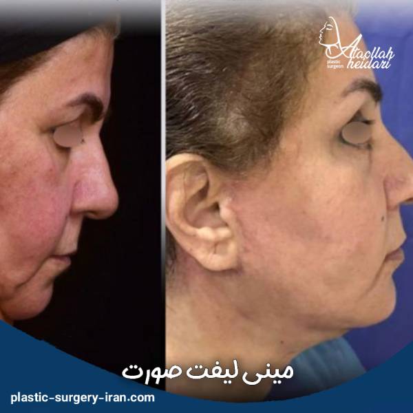 مینی لیفت صورت