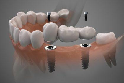کاندید مناسب برای ایمپلنت فوری