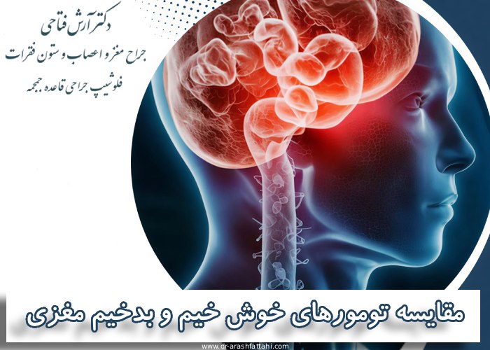 مقایسه تومورهای خوش خیم و بدخیم مغزی؛ تفاوت در درمان و پیش آگهی