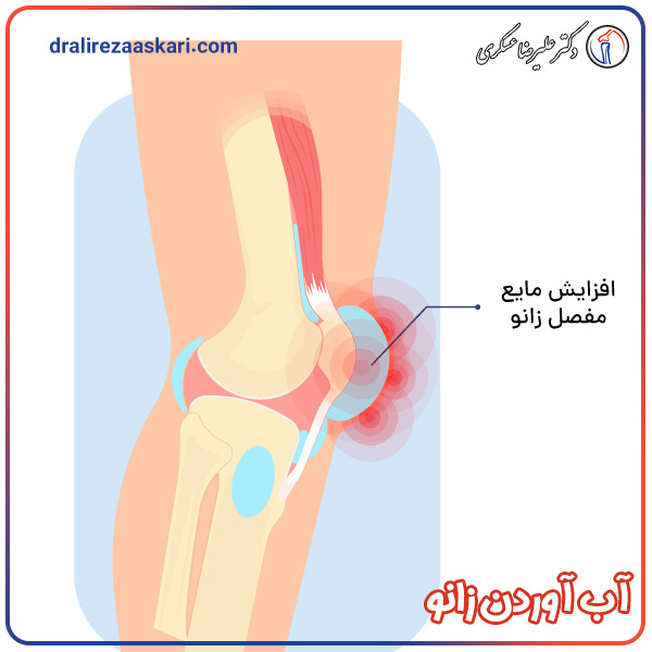 آب آوردن زانو | دکتر عسکری